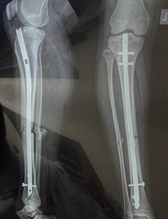 Ilustrasi foto scan tulang kaki. berita di bawah ini menceritakan sejumlah ciri-ciri kanker tulang yang seringkali diremehkan.