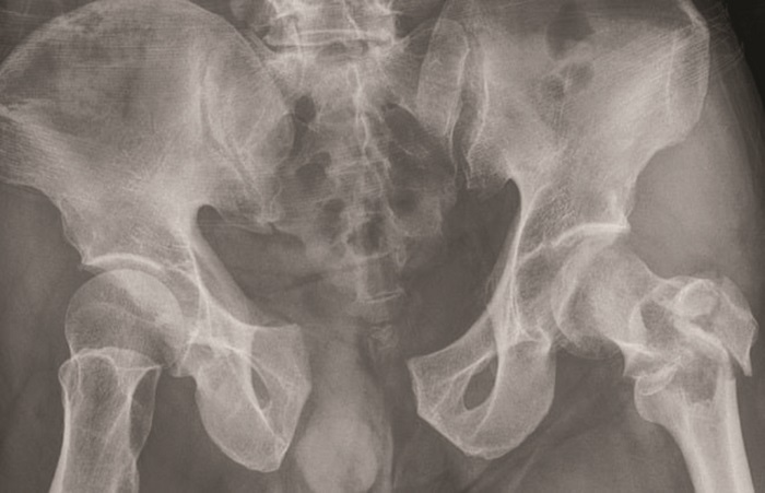 Citra Radiografi Penderita Fraktur Pelvis
