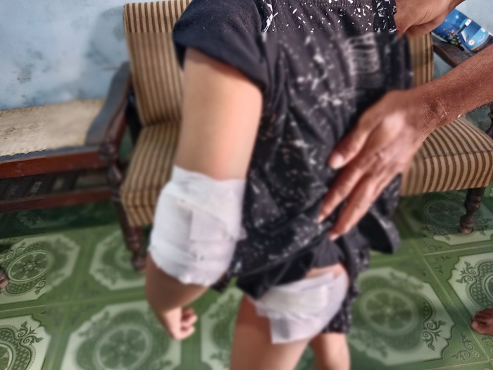 Seorang bocah perempuan berusia 6 tahun di Dusun Jombatan 1, Desa Jombatan, Kecamatan Kesamben, Kabupaten Jombang diserang monyet liar saat bermain sepeda di kebun belakang rumah tetangganya