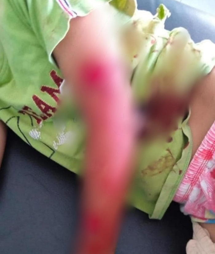 Serangan monyet liar di Kecamatan Kesamben terus berlanjut. Setelah sebelumnya dua anak di Jombatan, Jumat (18/7) siang giliran bocah berusia 12 tahun asal Desa Podoroto yang jadi korbannya.