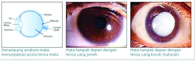 mau-operasi-katarak-pilih-rsud-jombang-saja-karena-menggunakan-fakoemulsifikasi-laser