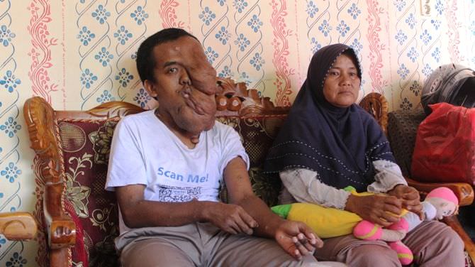 Khusnul Romadoni, Penderita Neurofibromatosis yang Butuh Uluran Tangan