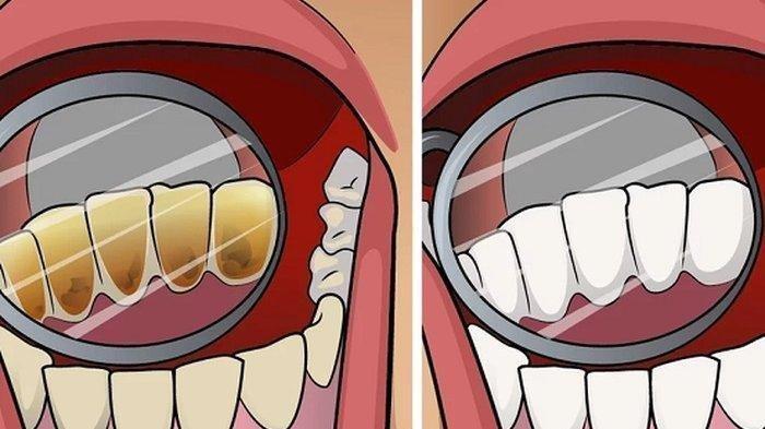 Ilustrasu. Gigi pecandu rokok (kiri) dan gigi tanpa konsumsi rokok (kanan)