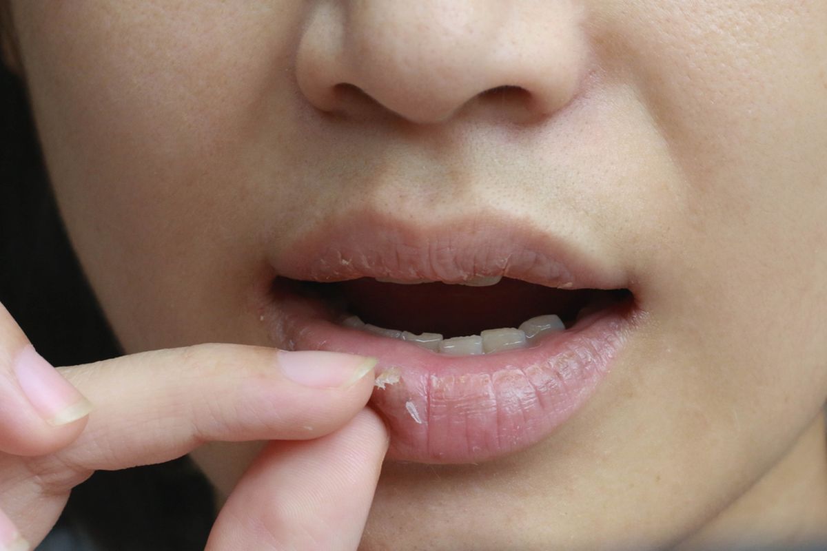 Ilustrasi. Bibir kering dan pecah-pecah
