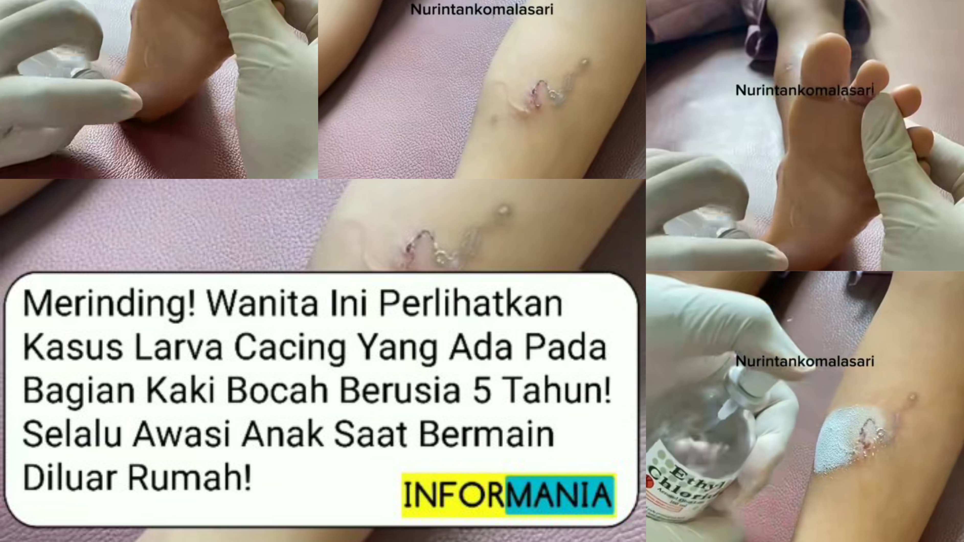Viral bocah 5 tahun infeksi larva cacing