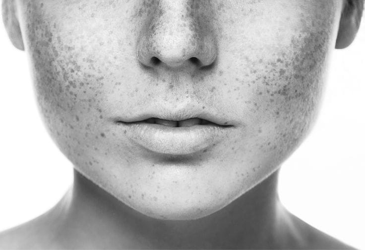 Dokter kulit menyarankan tujuh langkah penting untuk mencegah flek hitam setelah waxing