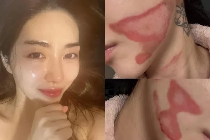 Kwon Mina tunjukkan luka bakar tingkat dua yang dialami usai lakukan treatment.
