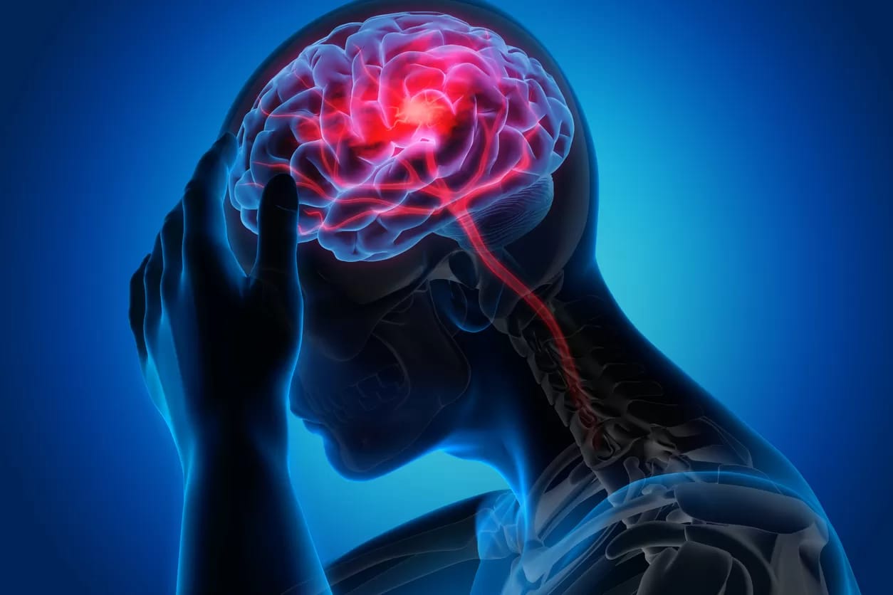Ilustrasi stroke.