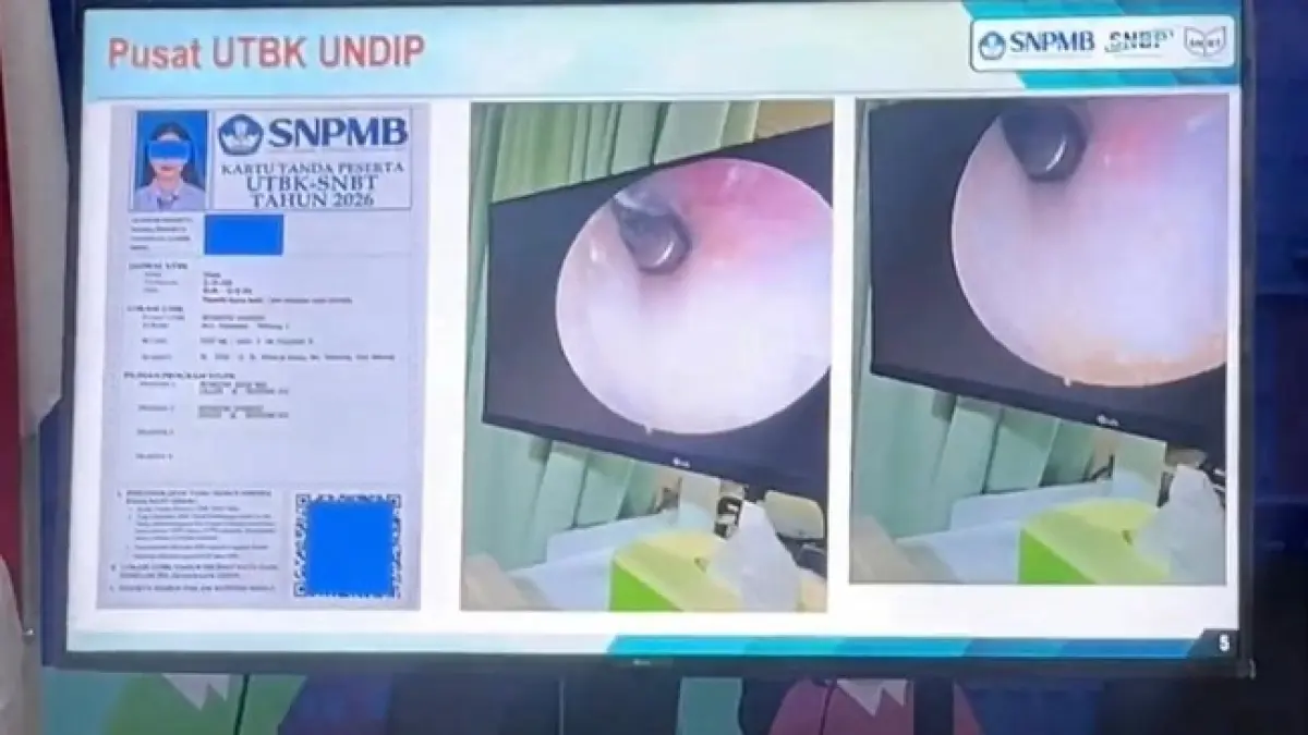 modus kecurangan dalam UTBK SNBT 2026 di Undip dengan menanamkan alat bantu dengar di lubang telinga. (Tangakapan layar media sosial)