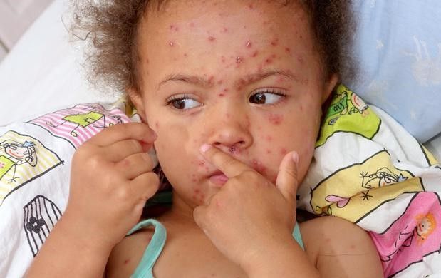 Ilustrasi: Gejala penyakit campak pada anak (Dok/JPC)