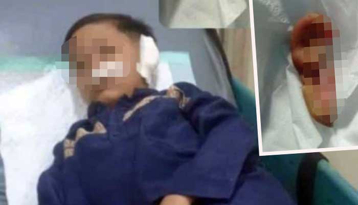 Kondisi korban saat dirawat di RS. Inset daun telinga korban putus usai digigit teman