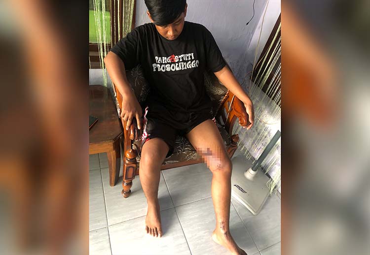 TERLUKA: Kaki Muhammad Izul Habibullah terluka usai menjadi korban percobaan begal di Kecamatan Kedopok, Kota Probolinggo, Senin (4/11) malam.