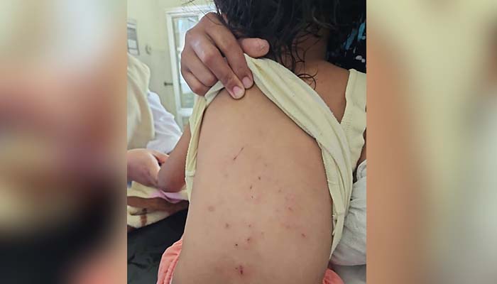 LUKA-LUKA: Kondisi punggung Nafa alami luka-luka usai diserang kera. Tangannya juga alami luka serius usai digigit kera