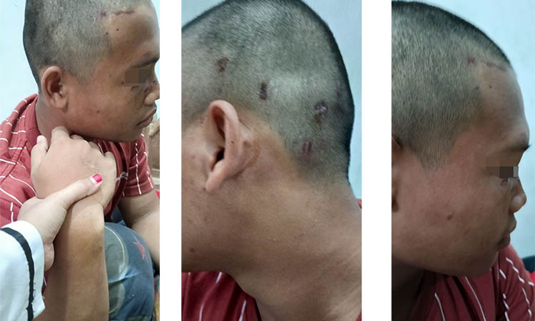 MENGAKU DIANIAYA: MK yang mengalami luka-luka setelah dipukul memakai knuckle.