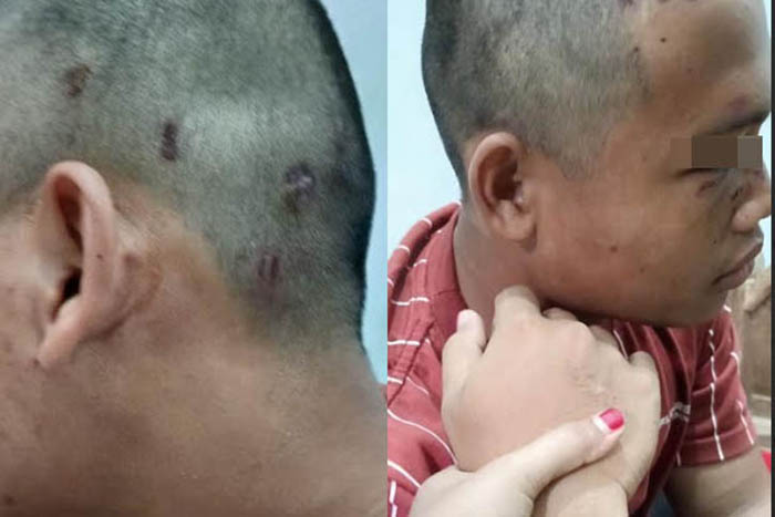 SUDAH DIVISUM: Luka yang dialami MMQ setelah dianiaya keamanan dan pengurus ponpes beberapa waktu lalu.