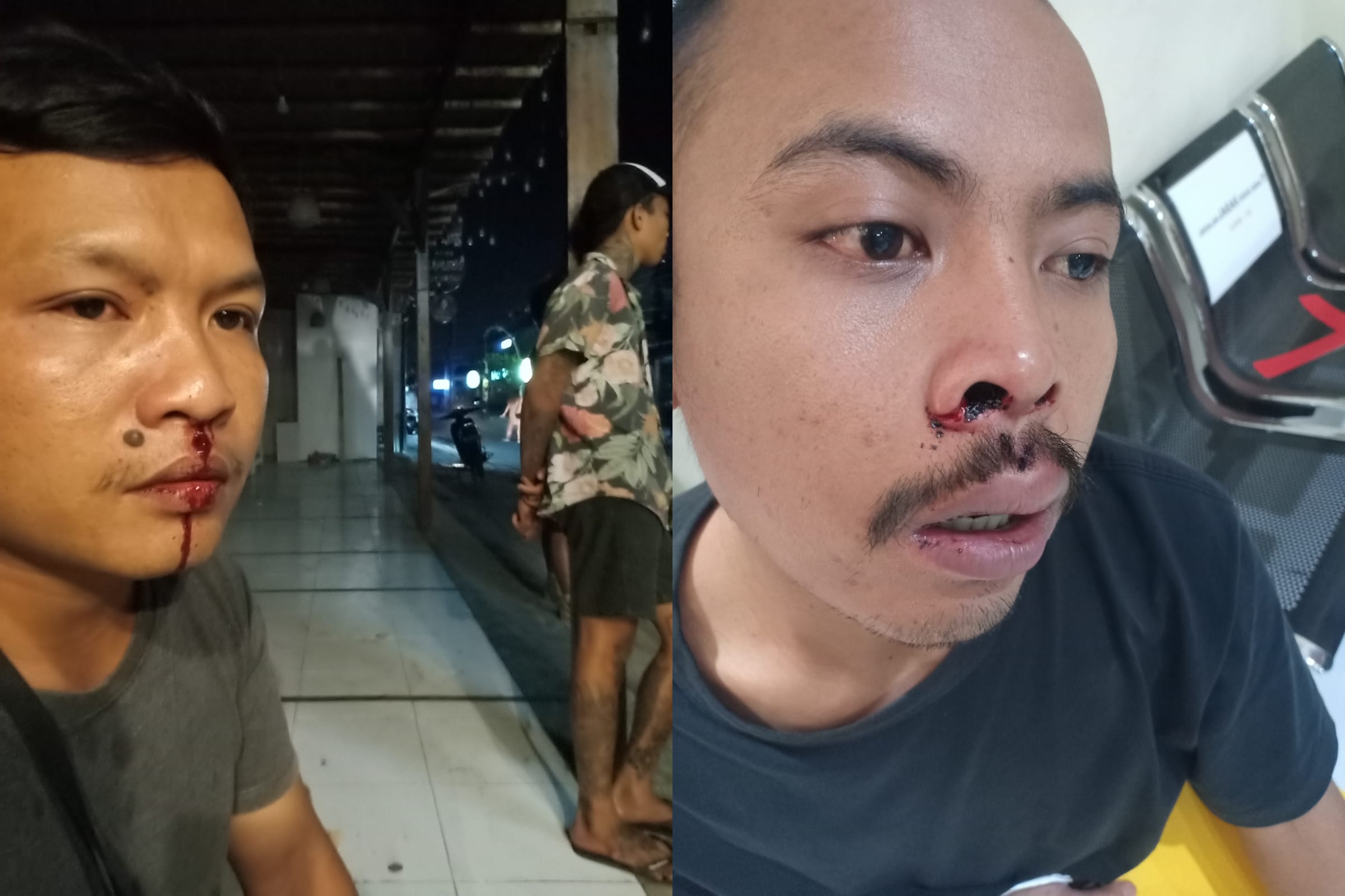 Sudarma dan rekannya menderita luka-luka akibat pemukulan warga asing di Pepino Pizza, Jalan Batu Bolong, Canggu, Kuta Utara.