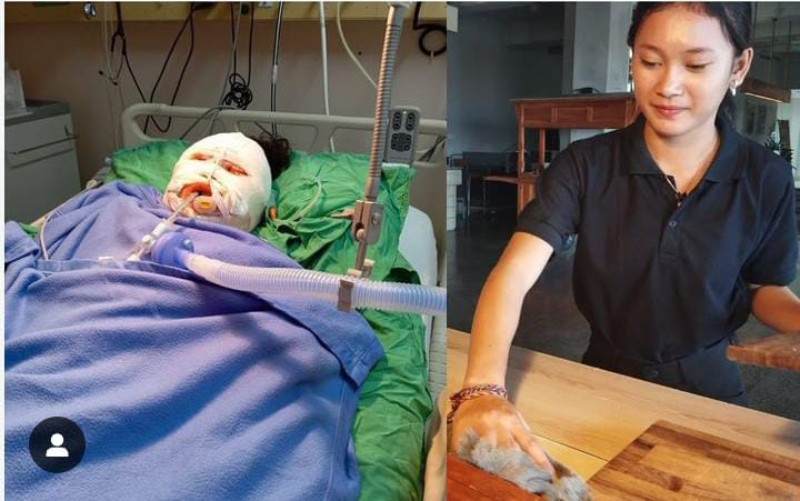 Kadek Ani siswi training yang alami luka bakar karena Sterno meninggal dunia