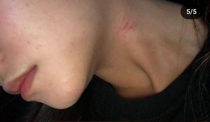 Viral di Instagram seorang gadis alami kekerasan yang diduga dilakukan oleh mantan kekasih