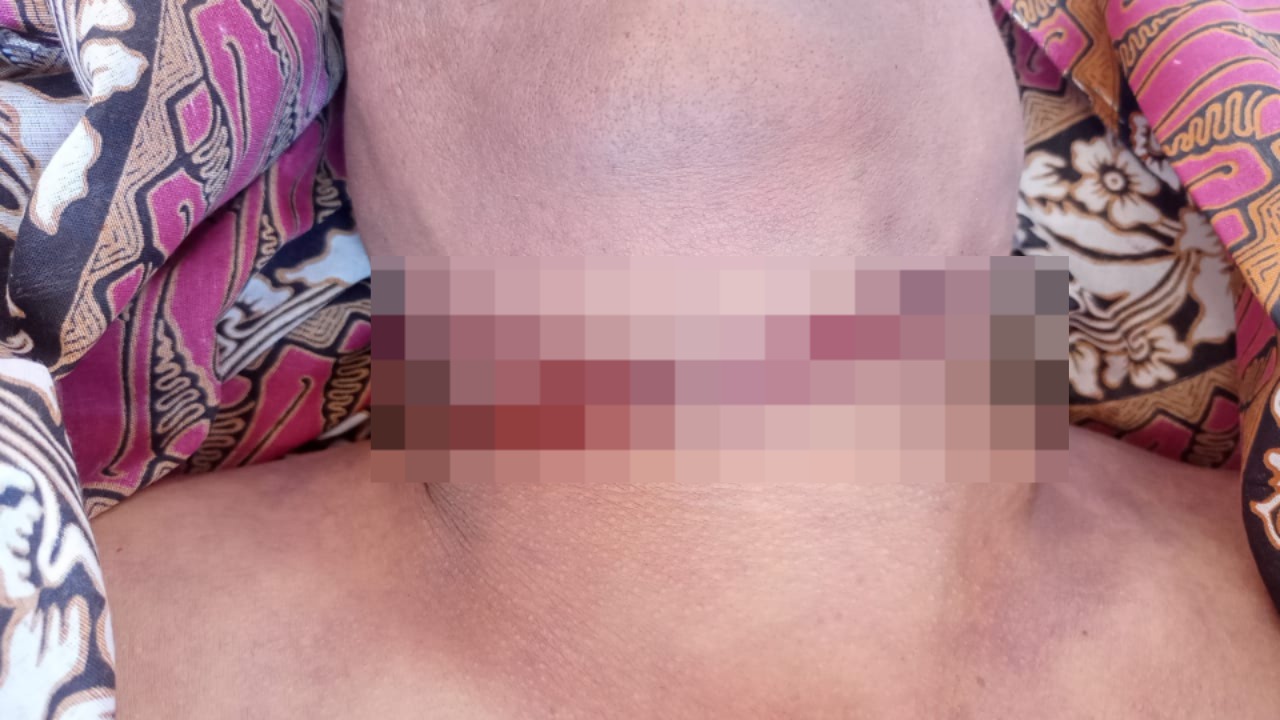 JANGGAL: Bekas jeratan tali dan cekikan terdapat di leher Widhiasa, sehingga diduga dia menjadi korban pembunuhan.