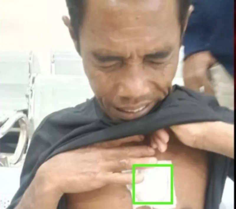 KEBAL: Suhadi, korban penusukan oleh buruh proyek vila di Batu Belig Kuta Utara saat diobati luka tusuk akibat ditikam pemilik warung (istimewa)