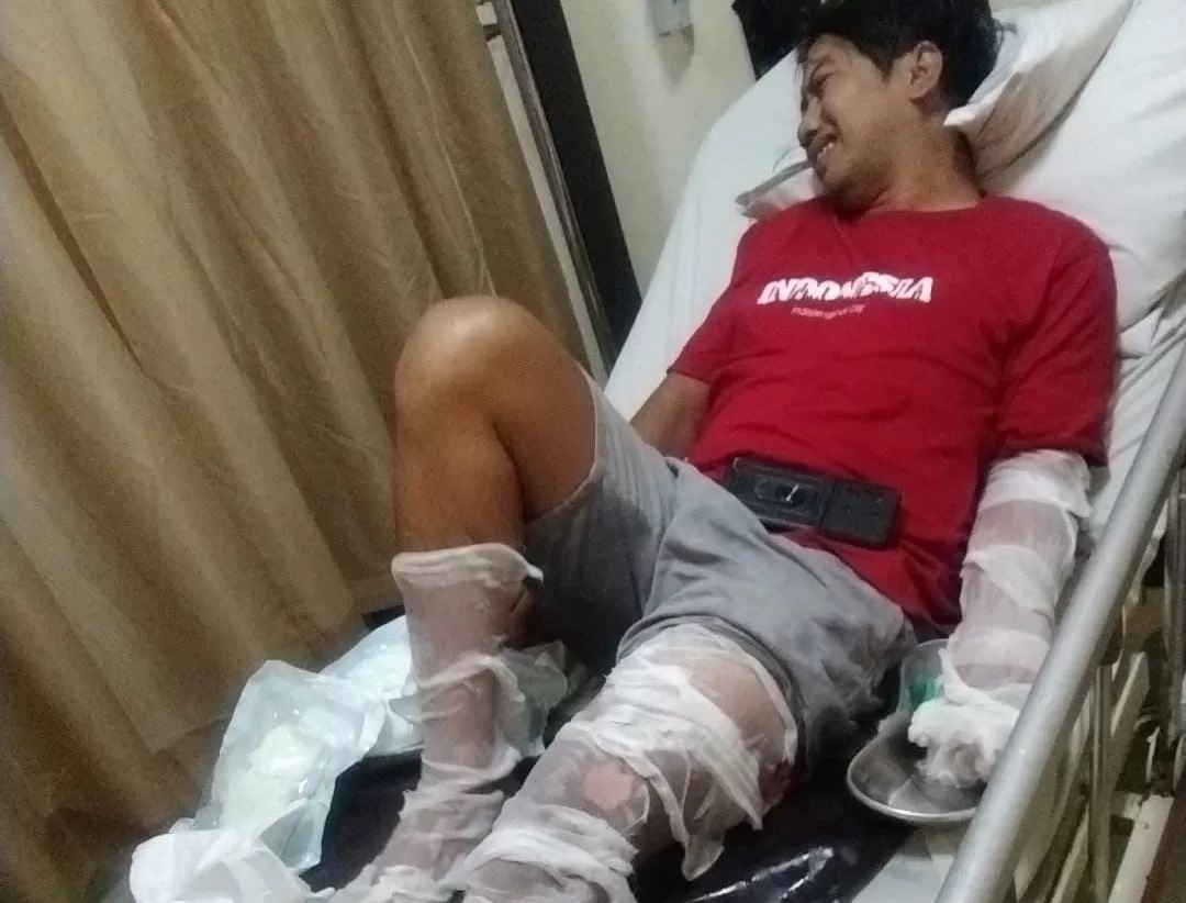 SIAL: Surahman, 32, nyaris tewas dengan sejumlah luka bakar di sekujur tubuh akibat meracik petasan kembang api untuk persiapan tahun baru (istimewa/radarbali.id)