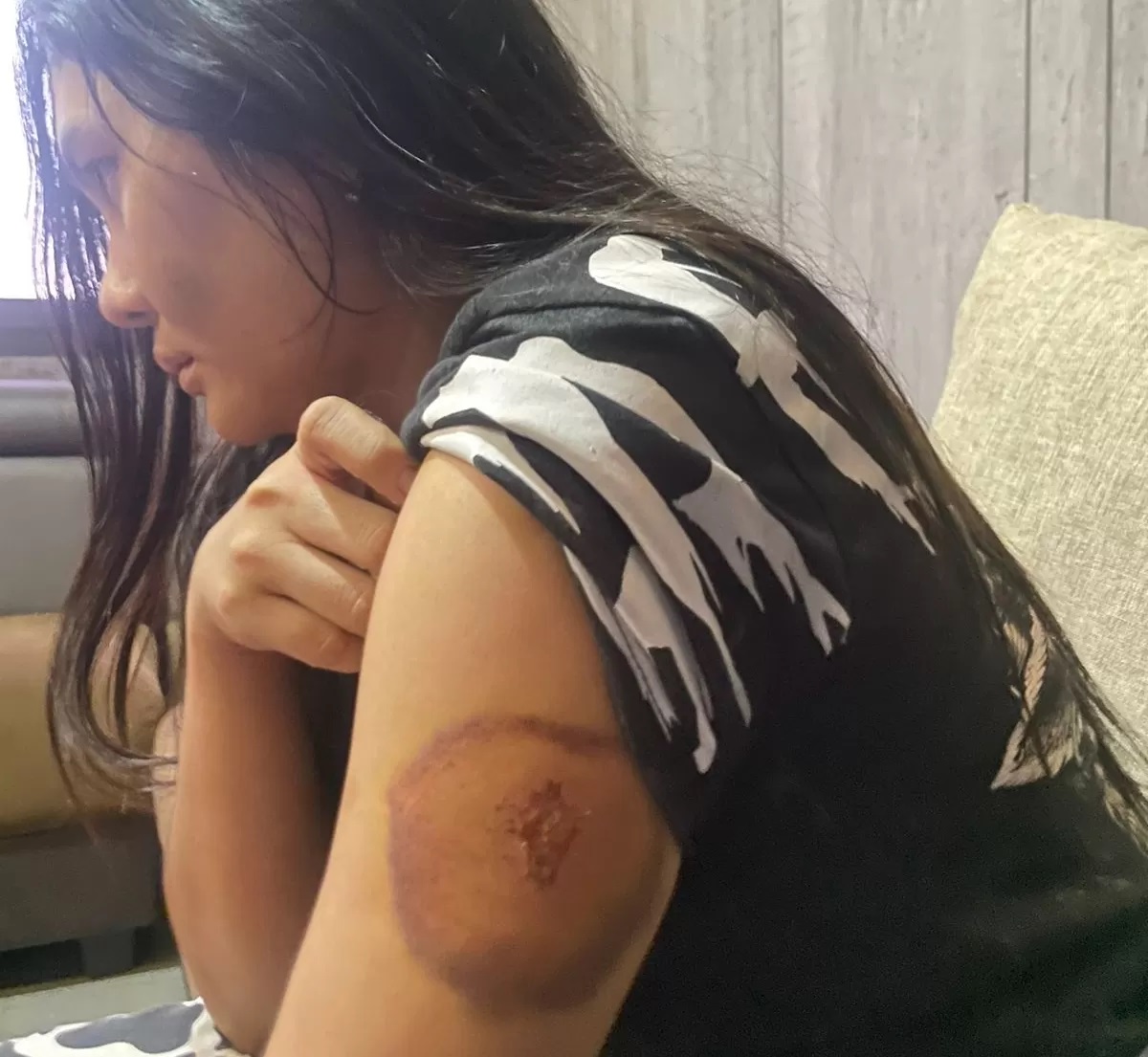 Memar : Korban KA alias Nana Rolex menunjukkan luka yang dialami akibat penganiayaan yang dialami oknum anggota DPRD Sampang. (Istimewa)