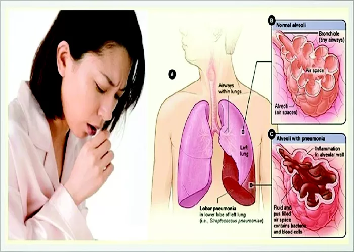 ilustrasi Tuberkolosis.