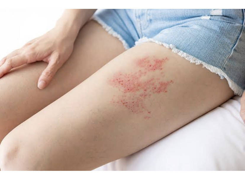 KENALI: Penyakit Herpes Zoster