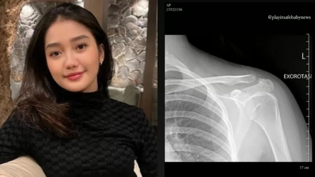 Selebgram Chandrika Chika (kiri) dilaporkan polisi terkait kasus penganiayaan terhadap warga yang sampai mengalami patah tulang bahu. (Foto: x @999o7i)