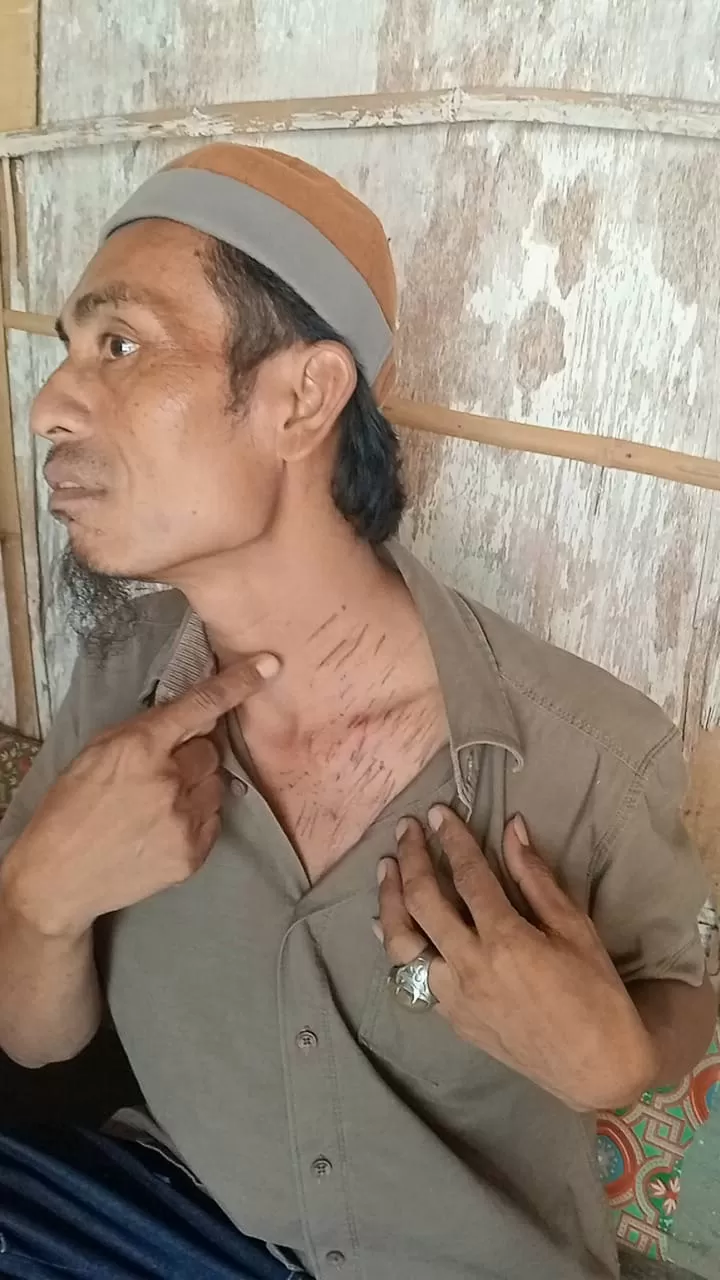 BERBEKAS: Kaderi menunjukkan luka di bagian leher dan dada di rumahnya di Kelurahan Kolpajung, Kecamatan Pamekasan, Kamis (20/3). (MOH. IQBAL AFGANI/JPRM)