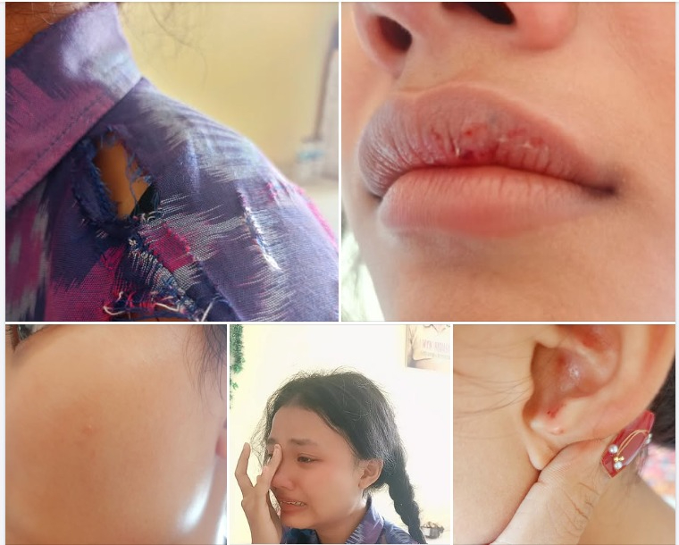 Siswa SMP di Bali Diduga Dibully Hingga Alami Luka Fisik