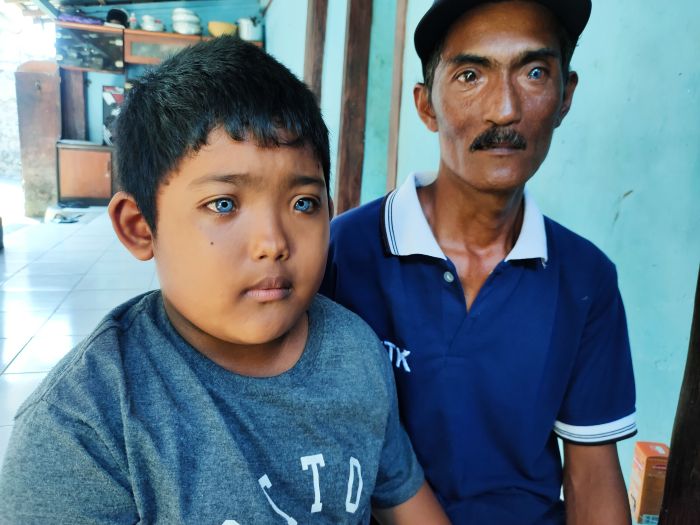 Ketut Adi Putra, bocah asal Singaraja yang memiliki bola mata biru.