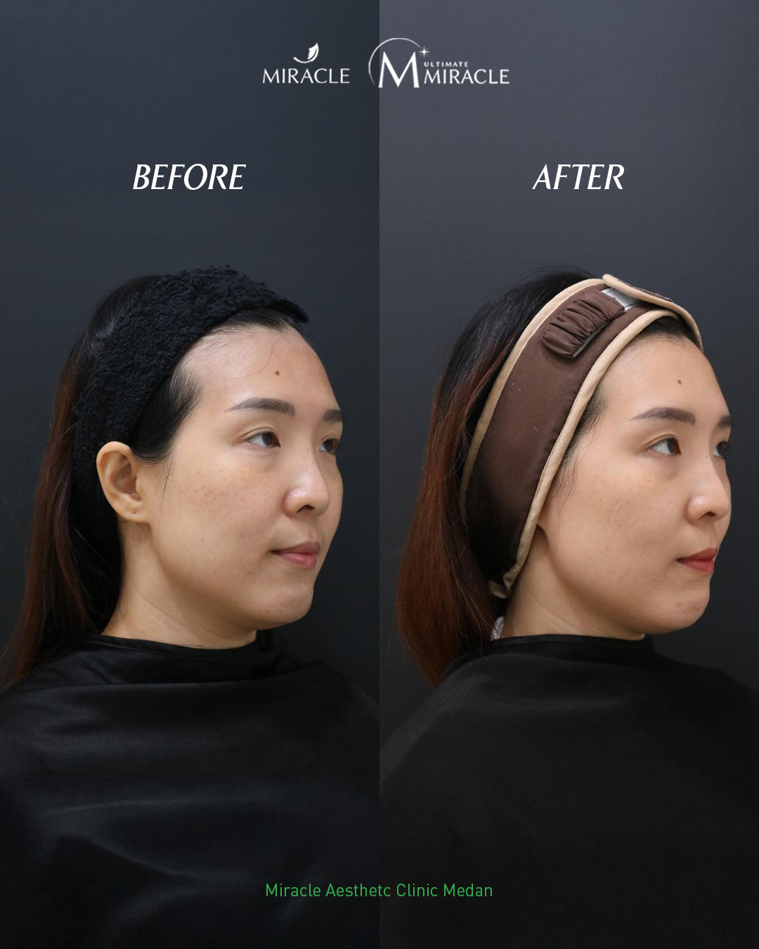 Miracle Pico Glow Toning