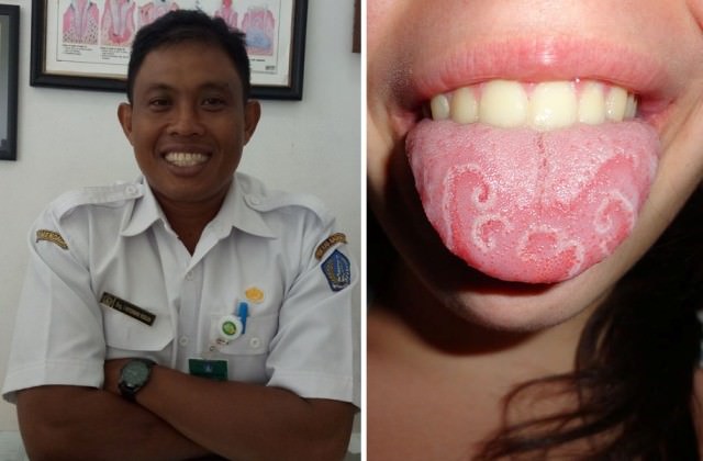 Geographic Tongue, Penyakit Susah Sembuh, Usia 20 Tahun Mulai Riskan