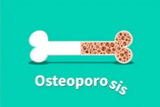 33 Persen Perempuan di Bali Beresiko Menderita Osteoporosis