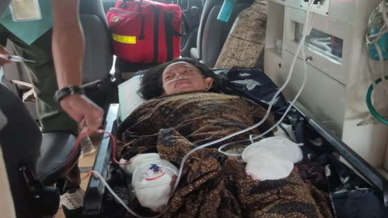 LUKA BAKAR: Ni Luh Juni Darmayanti, korban luka bakar akibat ledakan gas dirujuk ke RSUP Prof  Ngoerah. Ist