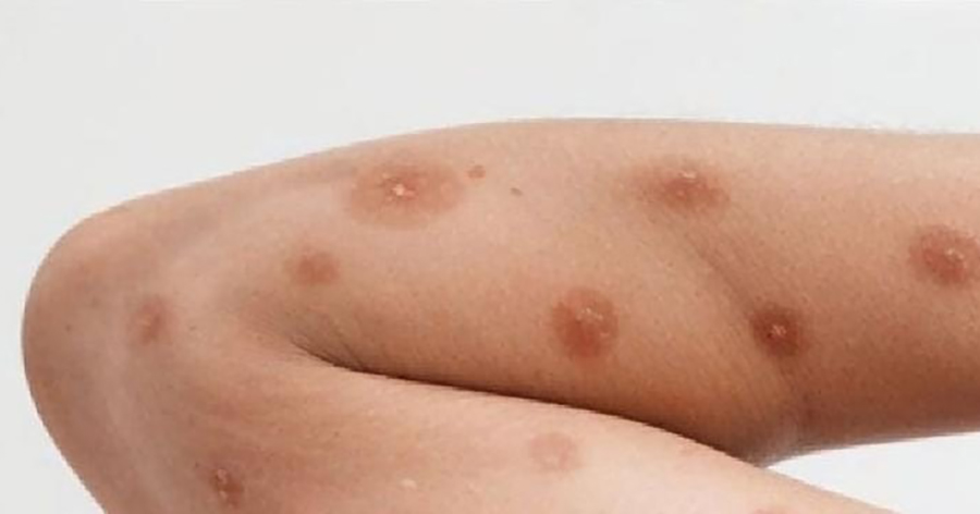 Seseorang yang terinfeksi cacar monyet. (ig @eka_hospital)