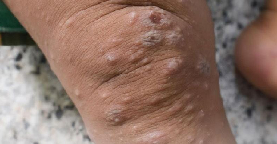 Ilustrasi cacar monyet. (ig @eka_hospital)