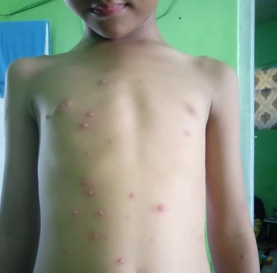 Istimewa  LEPAS BAJU: Seorang anak mengalami bentol-bentol lantaran sakit cacar air, Selasa (24/9).