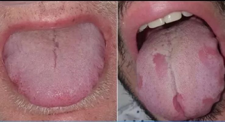 Ilustrasi sariawan pada lidah.