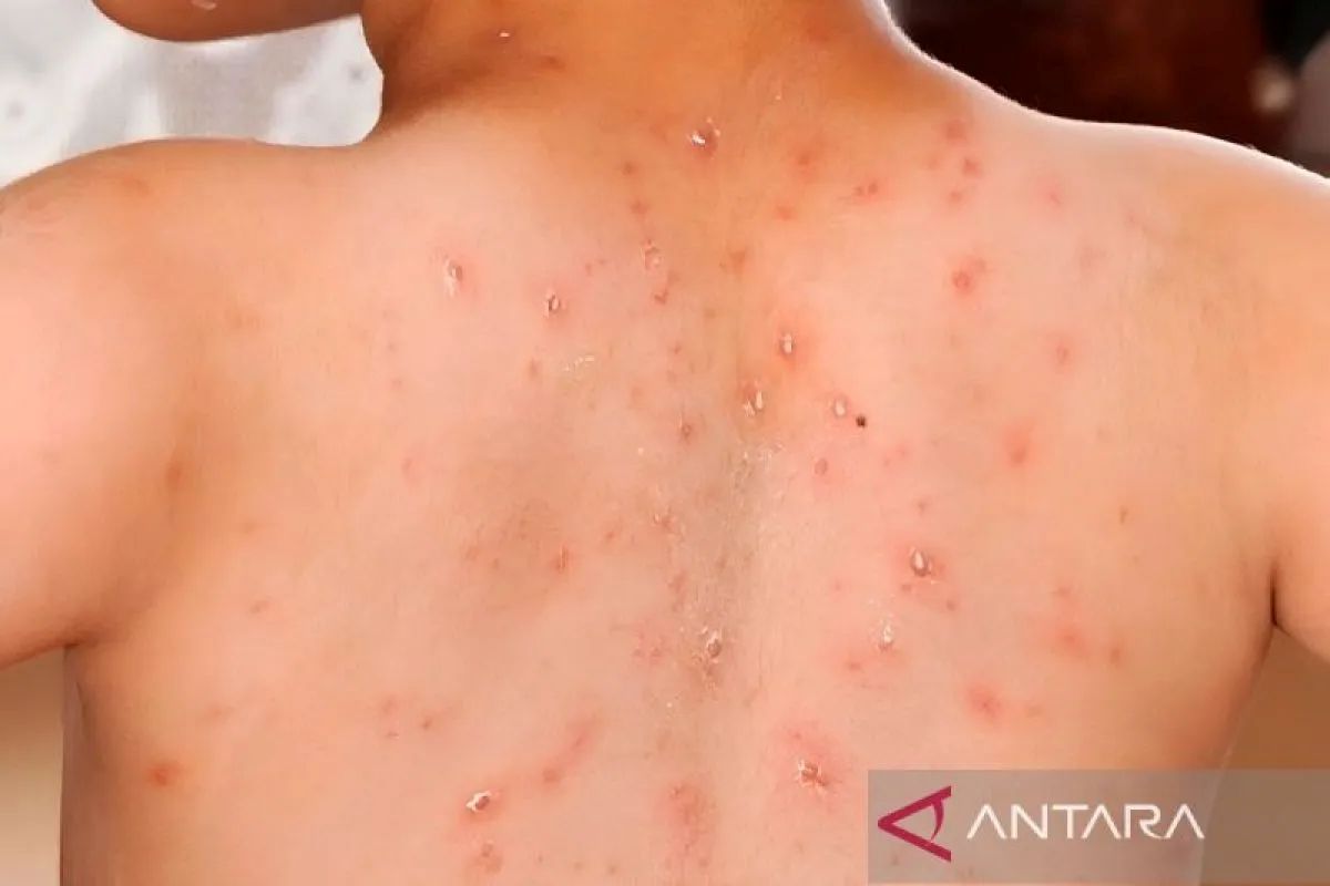 Ilustrasi penderita campak.