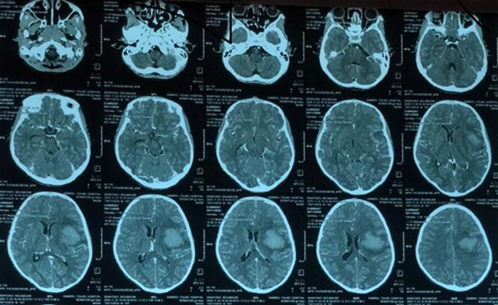 Tampilan CT-Scan yang mendukung stroke hemoragik dengan ventricular flooding.