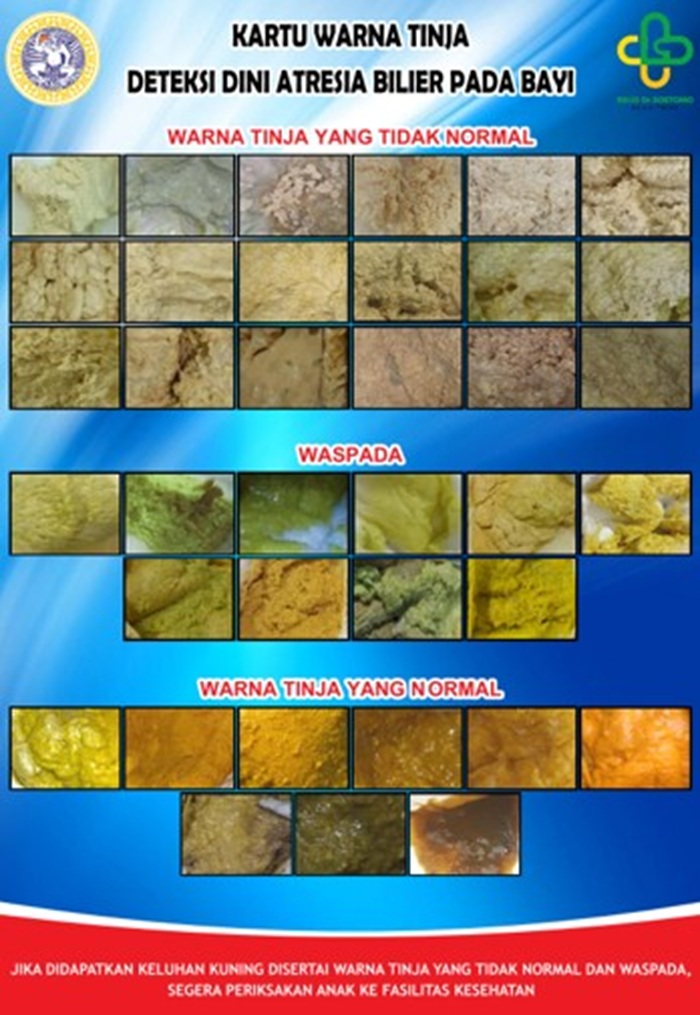 Kartu Warna Tinja &ldquo;Lokal&rdquo;