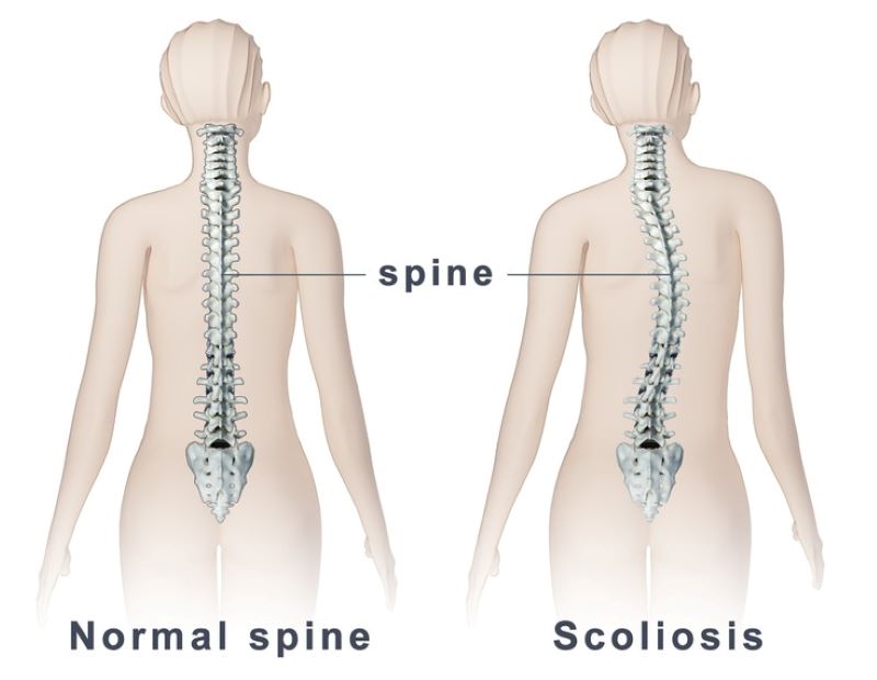 Ilustrasi Skoliosis tulang punggung. (Website/ Klinik Flex free)