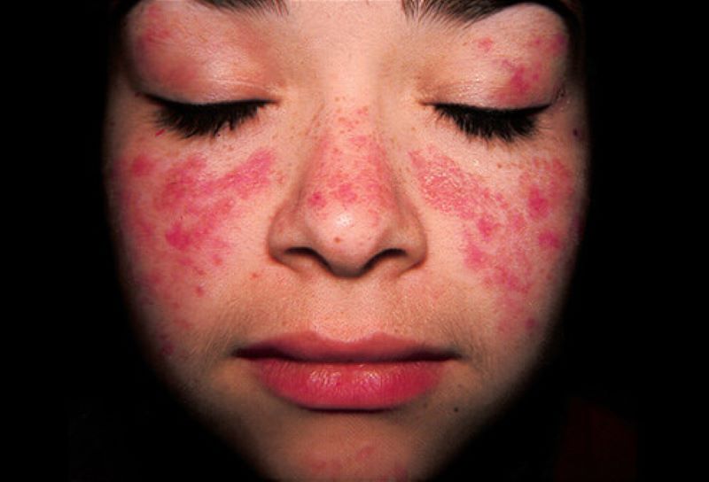 Penyakit lupus.