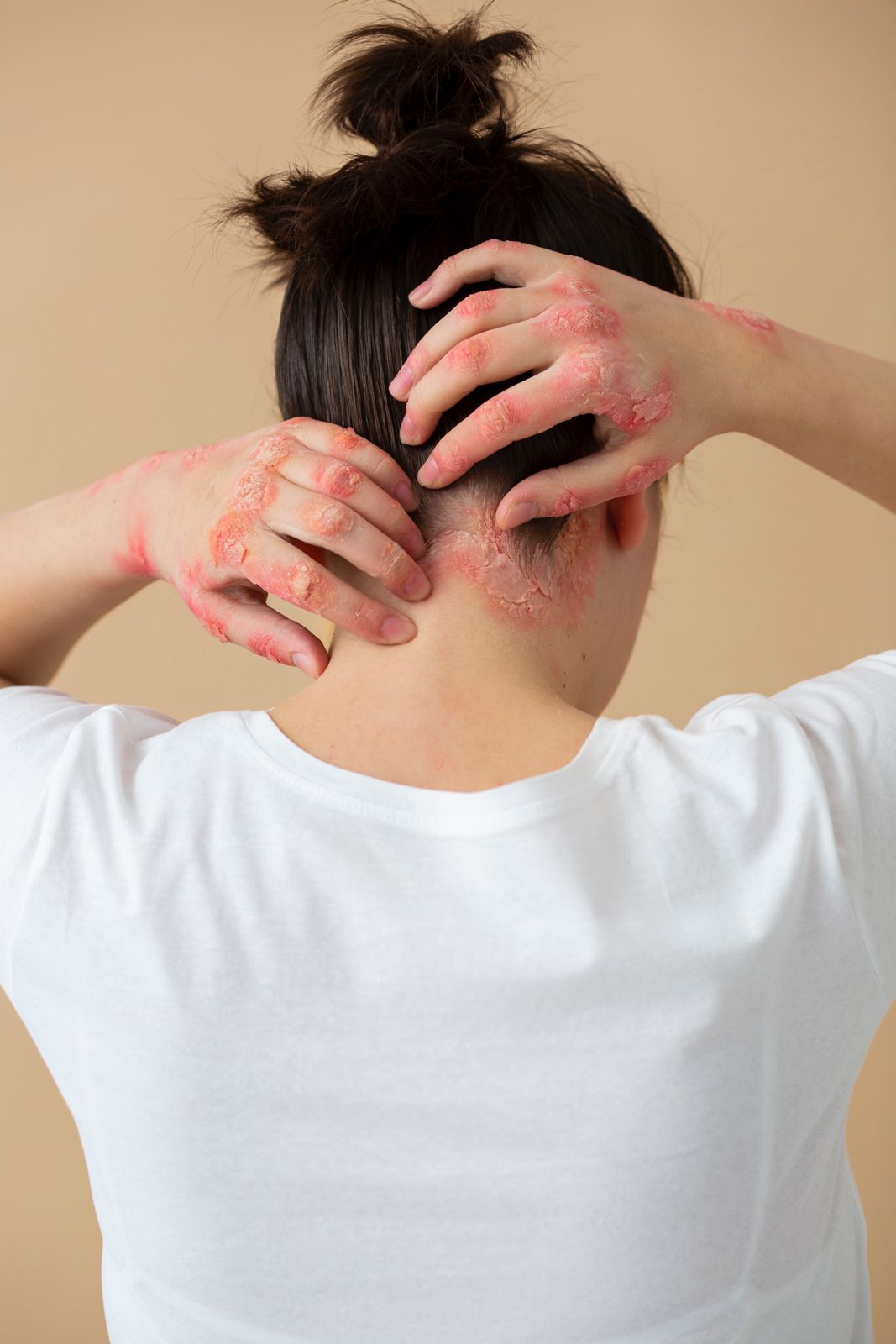 seorang wanita mengalami psoriasis