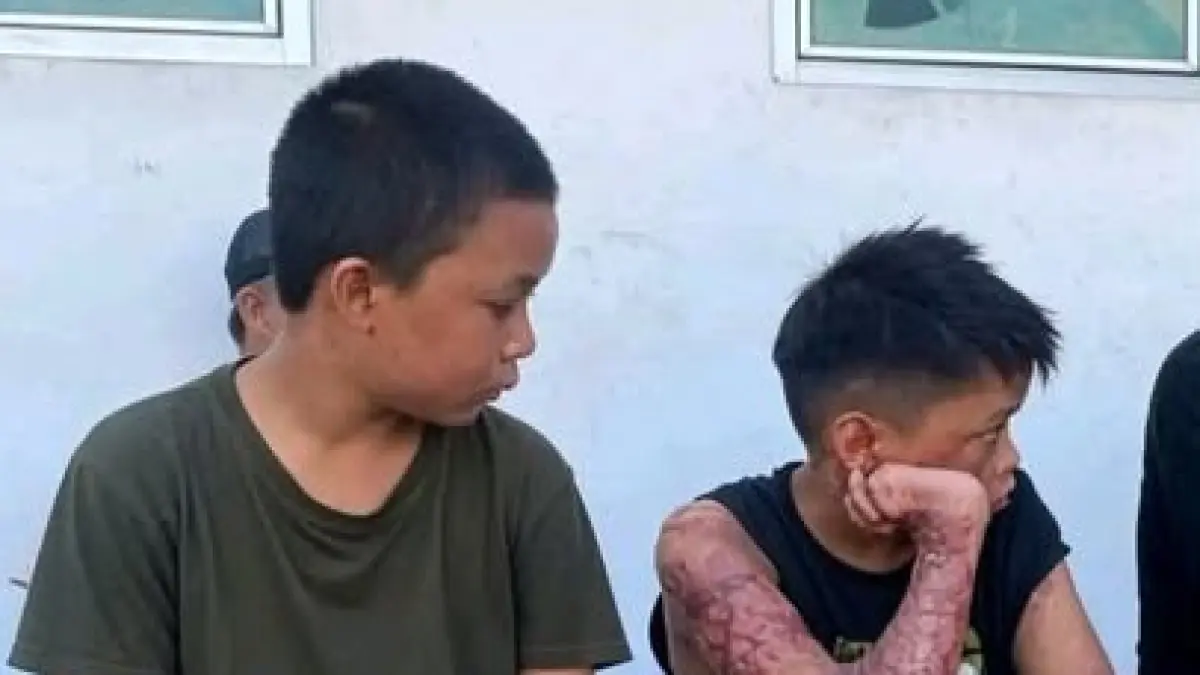 Dua santri korban dugaan pembakaran di sebuah pondok pesantren di Lombok menjalani perawatan akibat luka bakar serius yang diderita. (ISTIMEWA)