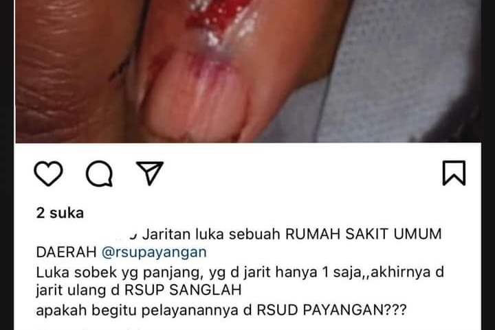 Seorang pasien RSUD Payangan memperlihatkan luka pada jarinya yang tampak masih menganga. Dia menulis unek-uneknya di media sosial.
