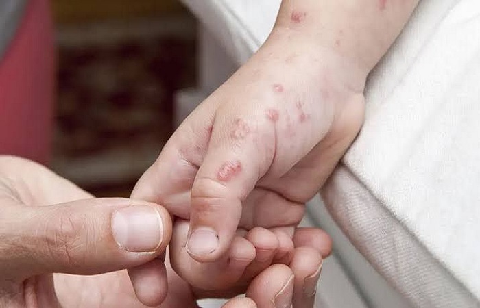 Foto ilustrasi penyakit cacar api atau Herpes Zoster.