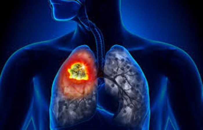 Ilustrasi, Pencegahan penyebaran kasus tuberkulosis (TB) di Kota Denpasar.